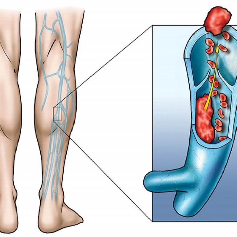 Венозный тромбоз глубоких вен нижних конечностей. Илеофеморальный венозный тромбоз. Тромбоз кровотечение
