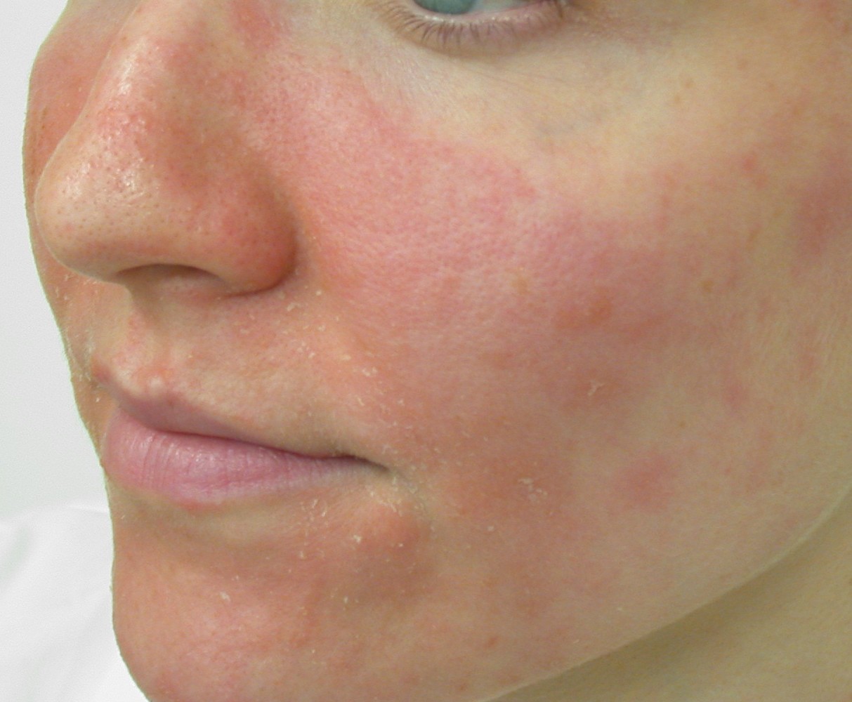 Экзема – это воспалительное заболевание кожи, имеющее длительное хроническо...